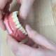 Implantate - Mit einem Zahn-Implantat zum gesunden Lächeln
