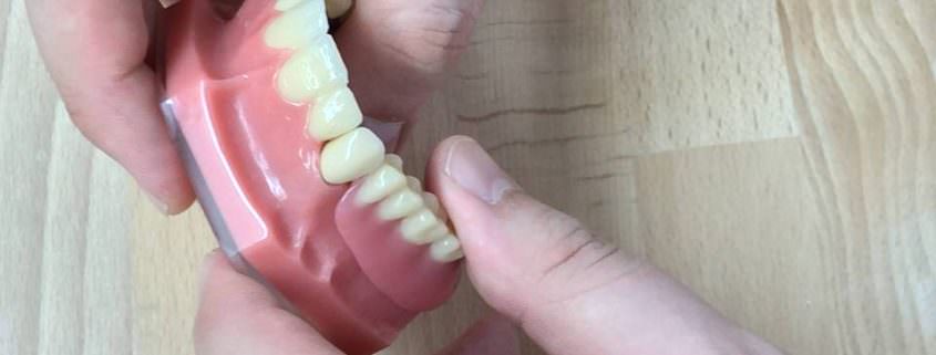 Implantate - Mit einem Zahn-Implantat zum gesunden Lächeln